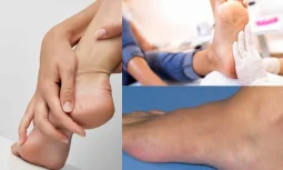 Pes Cavus Tedavisinde Egzersizlerin Önemi