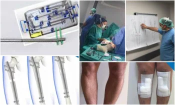 Bacak Uzatma Ameliyatı Maliyeti -Leg Lengthening Surgery Cost